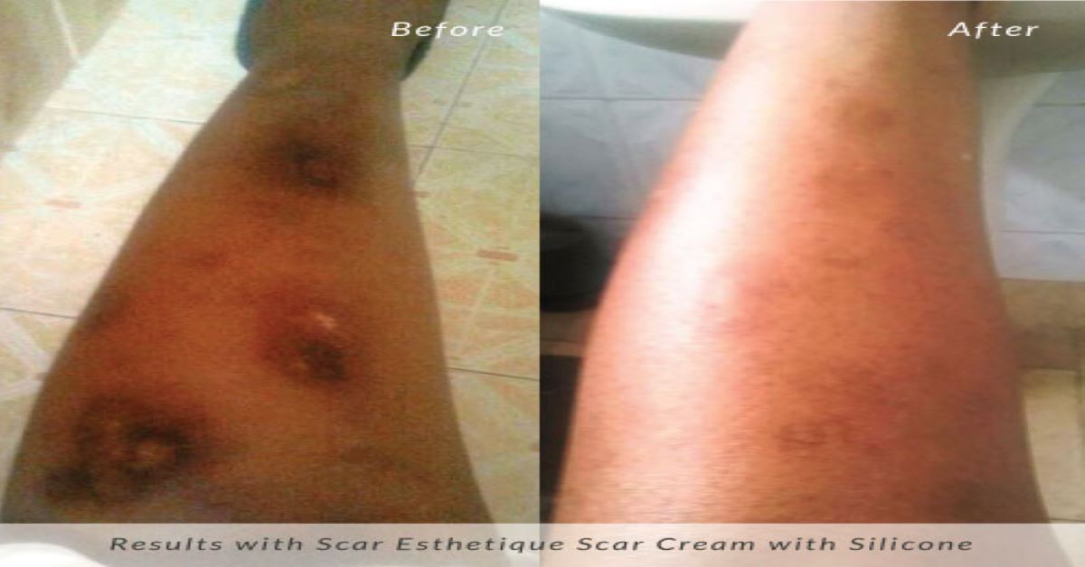 Leg burn scar before and after using Scar Esthetique