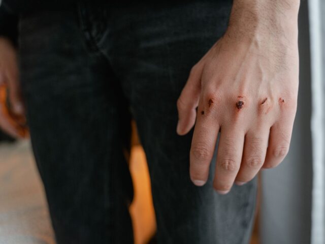 Hypertrophic Scar
