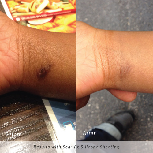 Keloid Scars