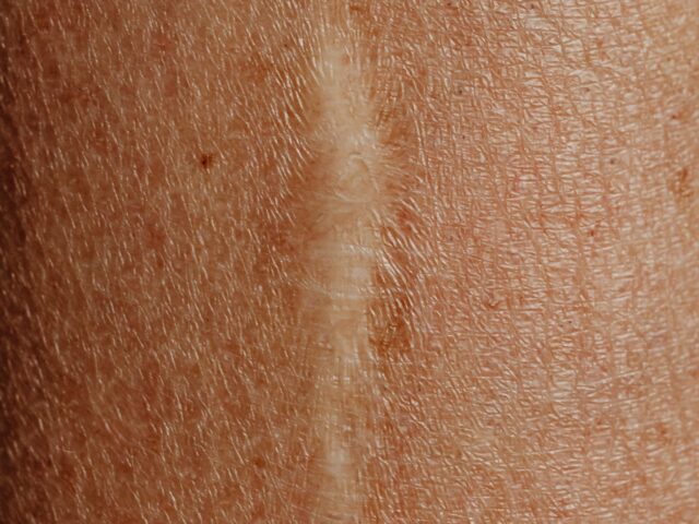 Scar Heal Information