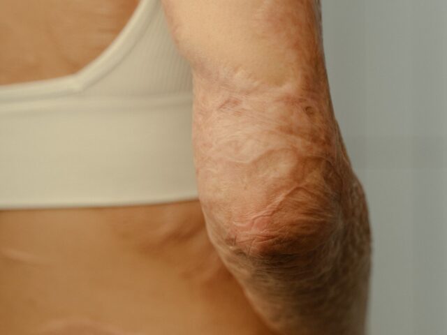 Scars – The different types of Scars