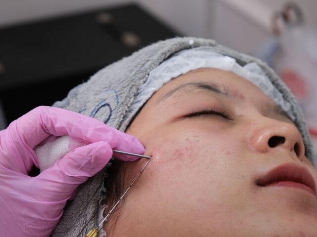 THREAD LIFT